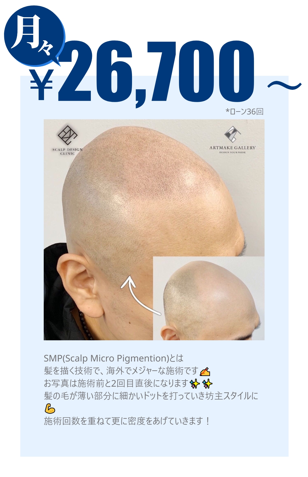 公式 Amgヘアアートメイク Aha 男性の薄毛に新提案 月々3 900円から
